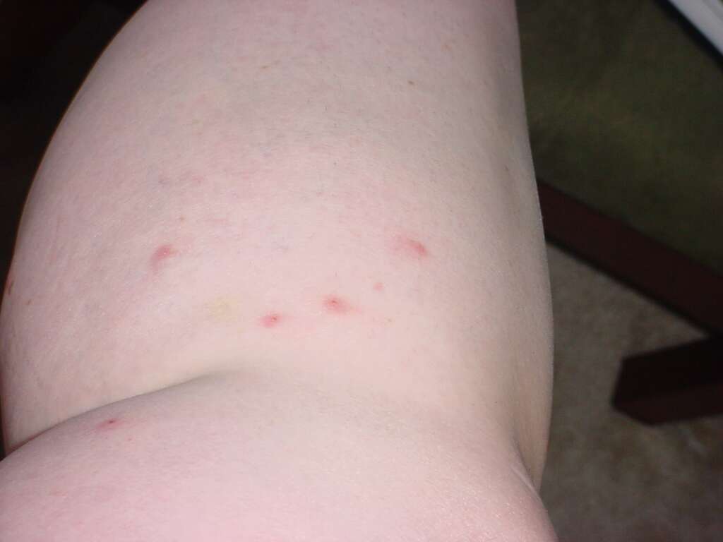 bed Bug Bites : Photos And Information