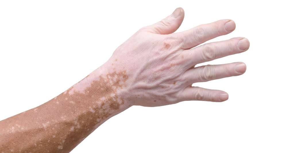 Les personnes qui souffrent de vitiligo — entre 0,5 et 2 % de la population — présentent des plaques blanches correspondant à des zones sur lesquelles les cellules qui produisent la mélanine ont disparu. Les nanoparticules synthétisées par des chercheurs américains pourraient venir s’y substituer. © gamelover, Fotolia