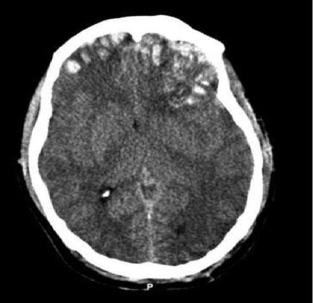 Cette image obtenue par scanner montre un traumatisme crânien. Le crâne a été déformé suite à un choc qui lèse certaines régions du cerveau. Il n'est pas toujours mortel mais peut entraîner de lourdes conséquences neurologiques. © Rehman et al., Wikipédia, cc by 2.0