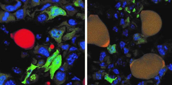 La thÃ©rapie de transdiffÃ©renciation testÃ©e chez la souris. Ã? gauche : cellules cancÃ©reuses exprimant la GFP (green fluorescent protein) en vert et adipocytes normaux en rouge, au niveau dâ??une tumeur. Ã? droite : les cellules cancÃ©reuses exprimant la GFP sont devenues des adipocytes qui apparaissent marron (vert + rouge). Â© DÃ©partement de BiomÃ©decine, UniversitÃ© de BÃ¢le,