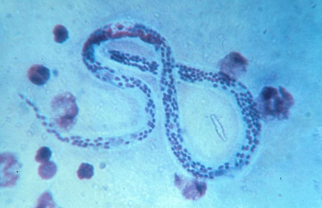 Le microfilaire de Bancroft provoque des difformités des membres. © Institut Pasteur